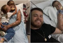 Xeroderma pigmentoso: a rara condição que fez do sol um perigo mortal para Káh Felipe