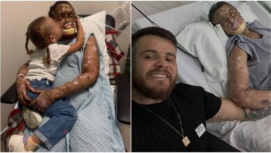 Xeroderma pigmentoso: a rara condição que fez do sol um perigo mortal para Káh Felipe