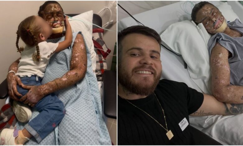 Xeroderma pigmentoso: a rara condição que fez do sol um perigo mortal para Káh Felipe