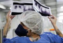 Cura do câncer de pulmão é rara com diagnóstico tardio no SUS