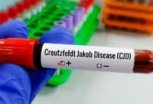 Doença de Creutzfeldt-jakob: entenda os desafios da condição rara e degenerativa