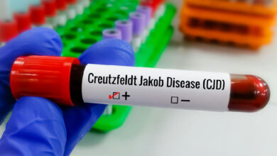 Doença de Creutzfeldt-jakob: entenda os desafios da condição rara e degenerativa