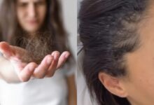 Queda de cabelo: por que buscar diagnóstico médico antes de iniciar tratamentos
