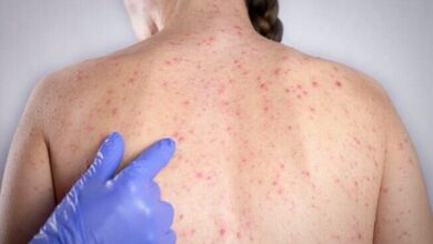 São Paulo registra 23 casos de sarampo e intensifica alerta para vacinação