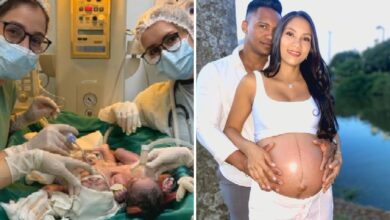 Gêmeos siameses nascem em Goiânia e passam por monitoramento na UTI neonatal