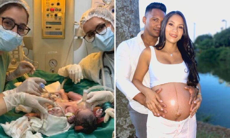 Gêmeos siameses nascem em Goiânia e passam por monitoramento na UTI neonatal