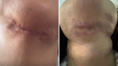 Vítima de dentista presa em Goiânia relata um ano de agonia e sequelas após cirurgias
