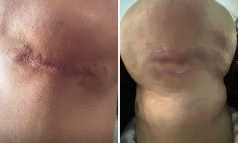 Vítima de dentista presa em Goiânia relata um ano de agonia e sequelas após cirurgias