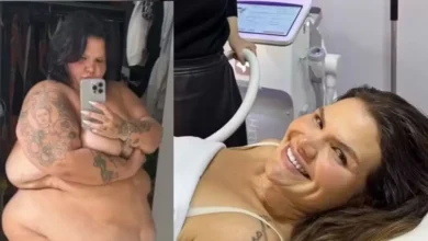 Thaís Carla busca tecnologias estéticas para tratar flacidez após perda de 100 kg