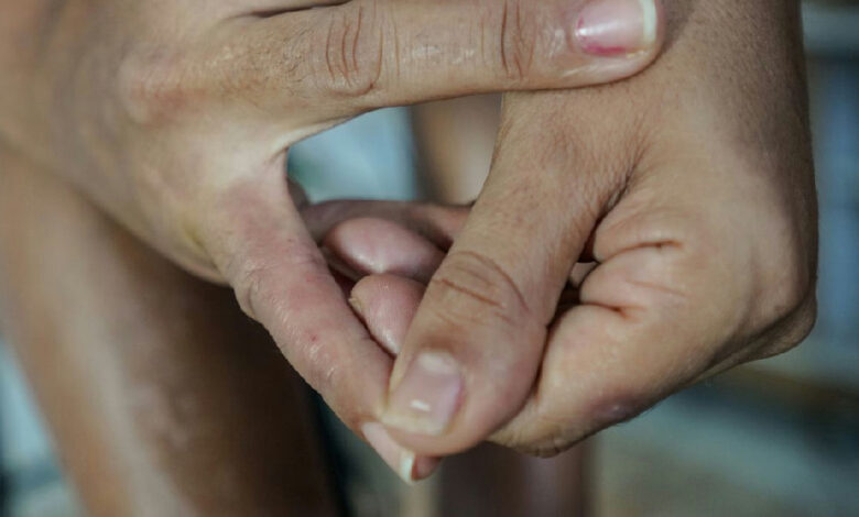 Dermatite atópica: doença crônica afeta pele, bem-estar e convívio social
