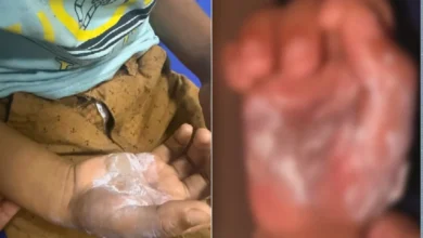Polícia prende mãe suspeita de torturar filho de 7 anos com colher quente em Cidade Ocidental