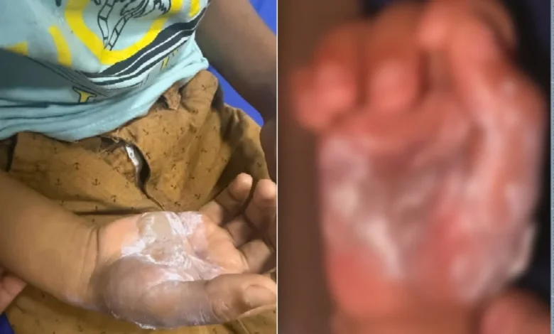 Polícia prende mãe suspeita de torturar filho de 7 anos com colher quente em Cidade Ocidental