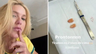Virginia Fonseca passa por cirurgia para extração de sisos após crises de dor