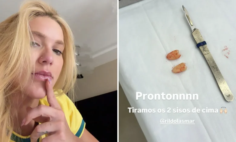Virginia Fonseca passa por cirurgia para extração de sisos após crises de dor
