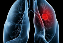 Entenda o adenocarcinoma pulmonar, diagnóstico que levou o Papa Leão à cirurgia