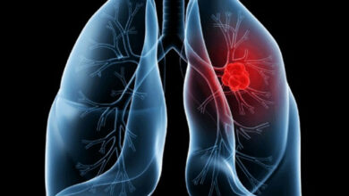 Entenda o adenocarcinoma pulmonar, diagnóstico que levou o Papa Leão à cirurgia