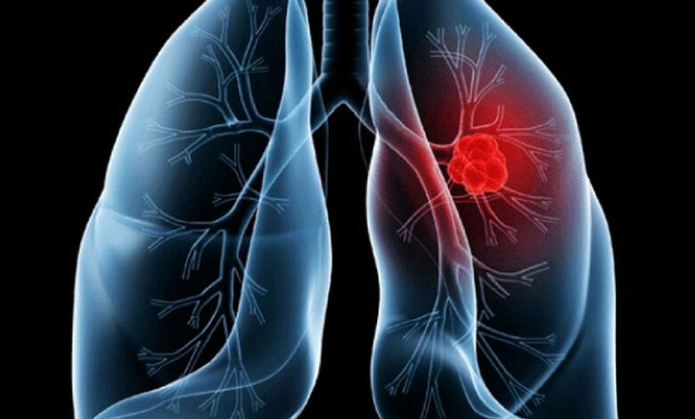 Entenda o adenocarcinoma pulmonar, diagnóstico que levou o Papa Leão à cirurgia