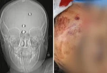Menino baleado na cabeça em Goiás apresenta melhora e volta a falar após sair da sedação