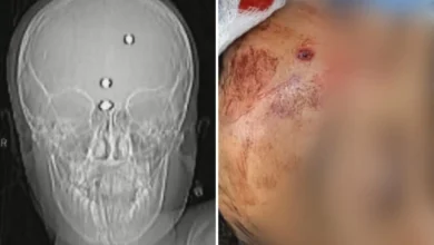 Menino baleado na cabeça em Goiás apresenta melhora e volta a falar após sair da sedação