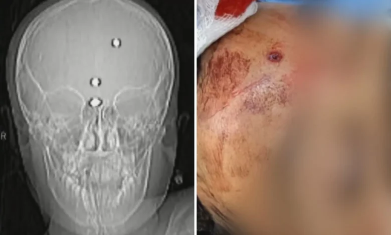 Menino baleado na cabeça em Goiás apresenta melhora e volta a falar após sair da sedação