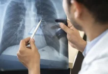 País amplia opções terapêuticas com aval da Anvisa para novos remédios contra câncer